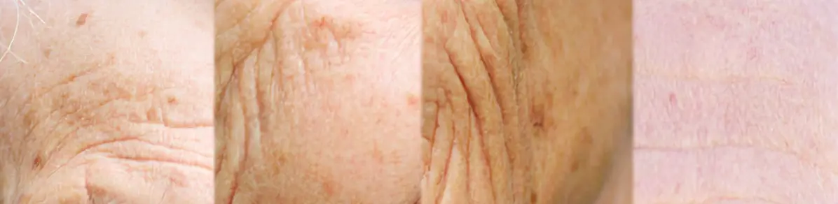 images montrant les différentes peaux chez les personnes âgées
