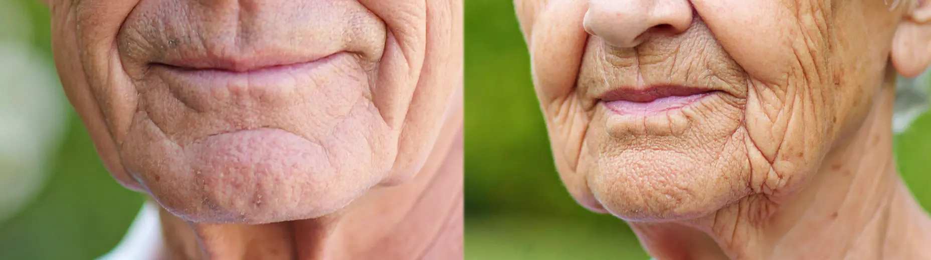 images montrant les volumes du visage chez les personnes âgées